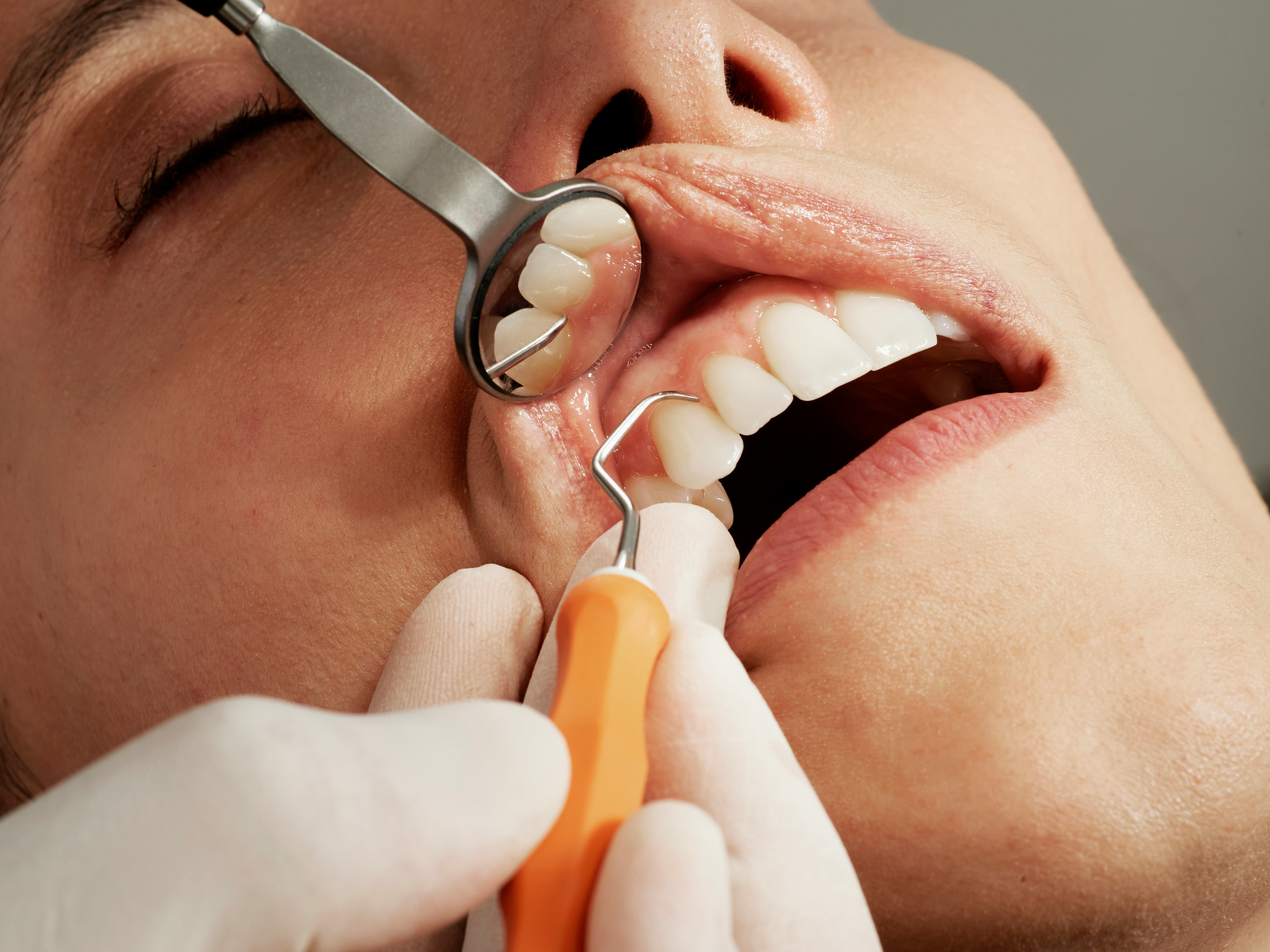General dentistry services in Auckland - preventive dental care, cleanings, fillings, check-ups at Smile Boutique clinics